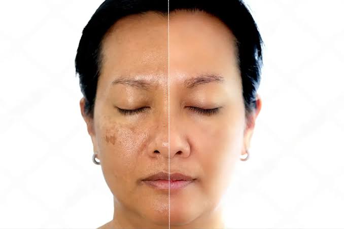 Melasma sob controle
